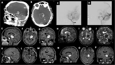 Diagnostic and surgical management of primary central nervous system angioleiomyoma: A case report and literature review